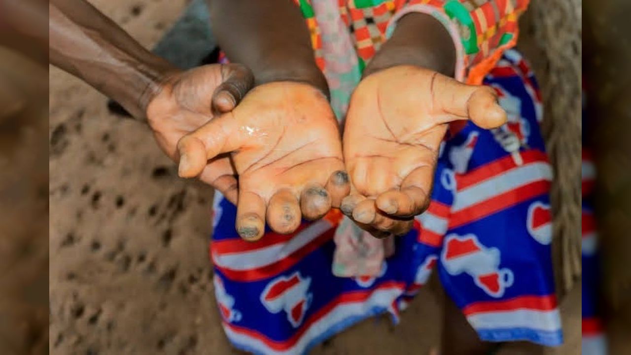 sauvons les enfants atteints de la lepre
